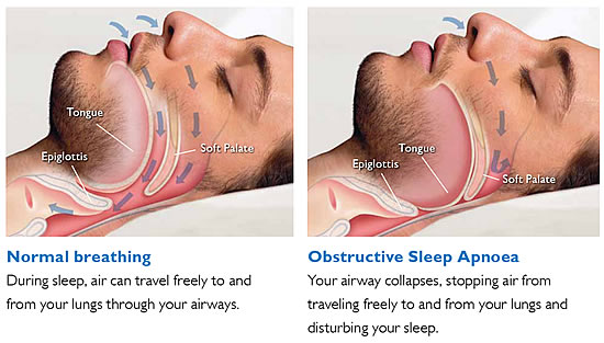 obstructive-sleep-apnea